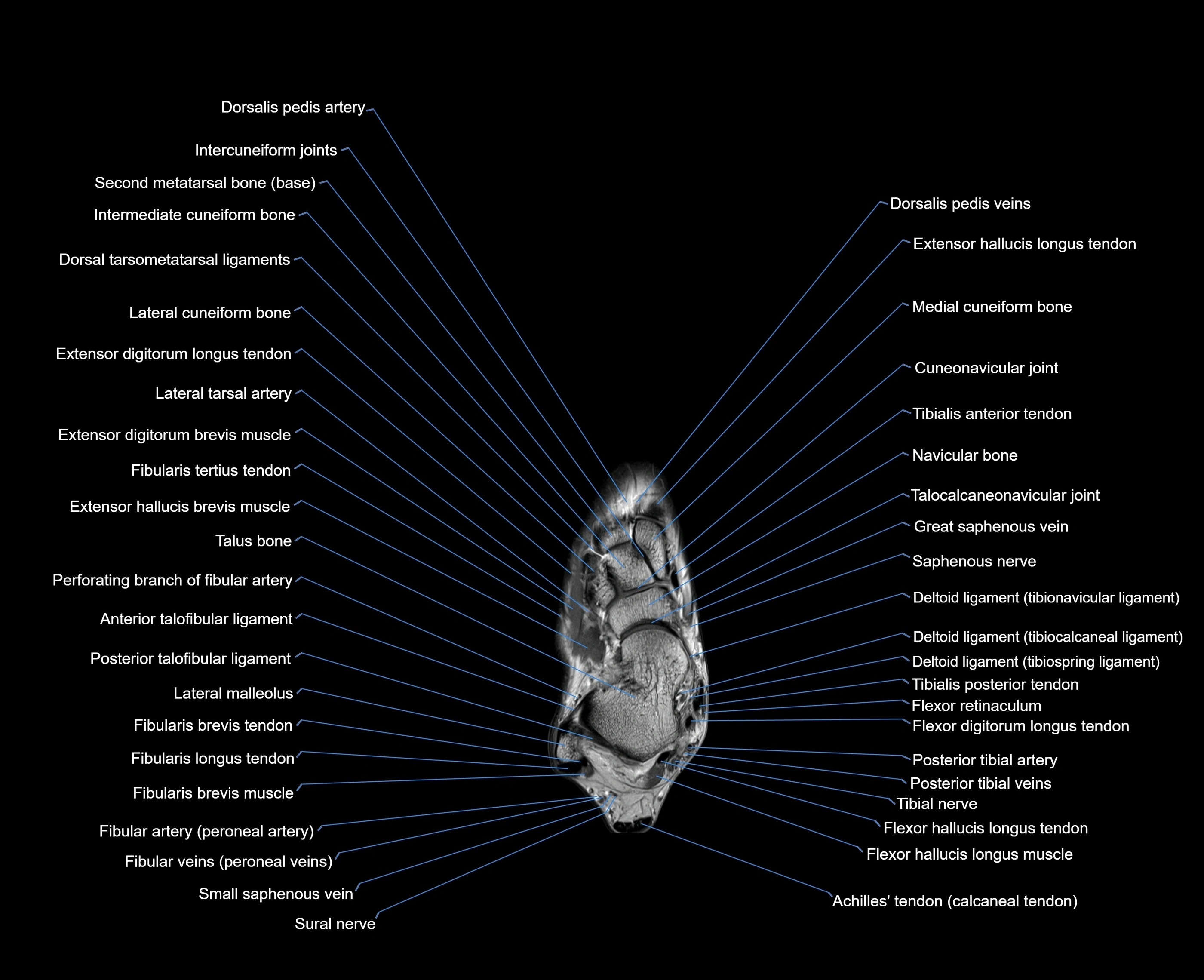 MRI foot coronal cross sectional anatomy 3T  radiology  image-img-00001-00012.webp